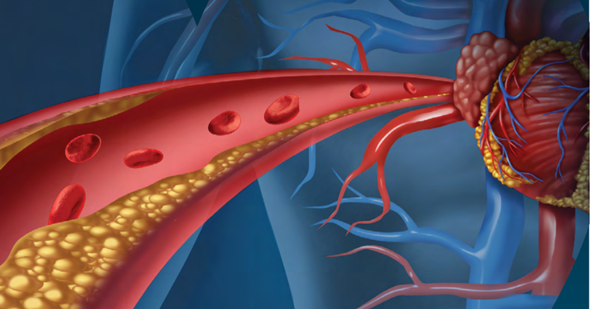 An illustration of plaque buildup in arteries that restricts blood flow.