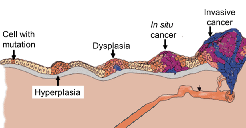 A simplified diagram of normal cells in the human body mutating into cancer cells.